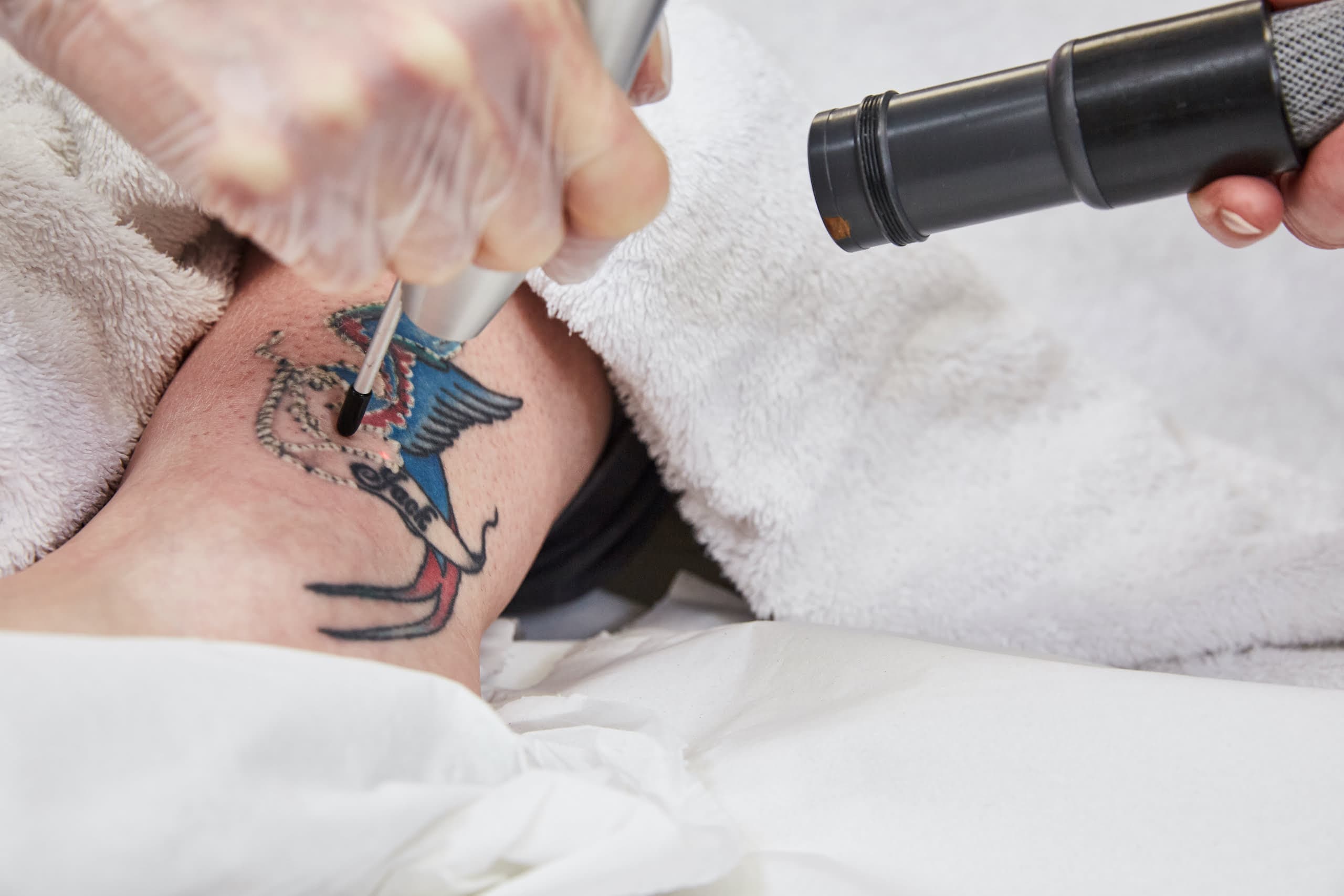 VTCT Laser Tattoo Removal Course UK Guide (2026)
