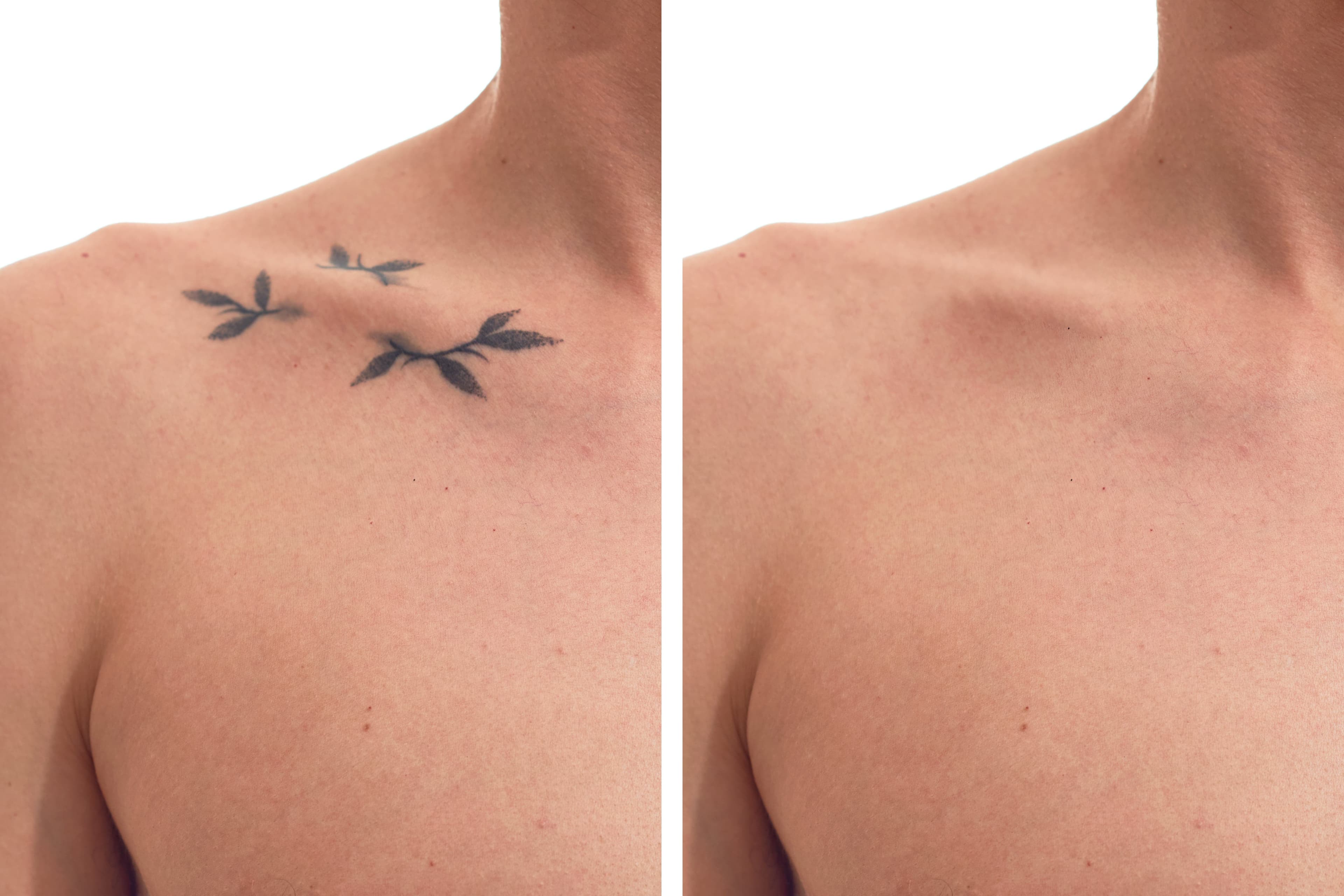 Laser Tattoo Removal Training UK: Complete Route and Qualification Guide