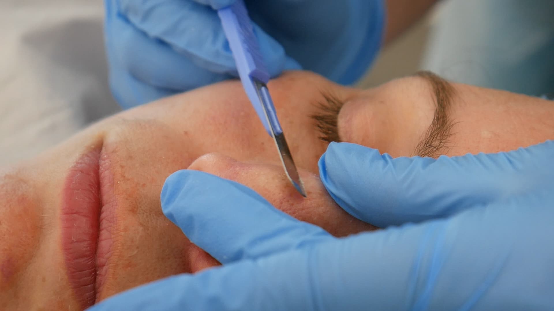 Dermaplaning Training