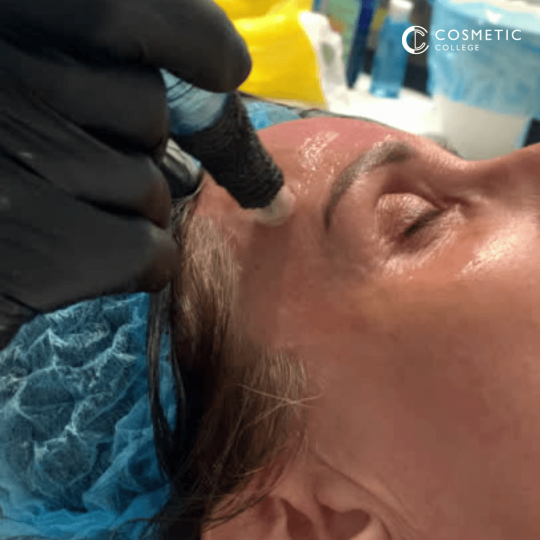 Elevate Your Expertise: Why Upgrade to Level 4 in Microneedling