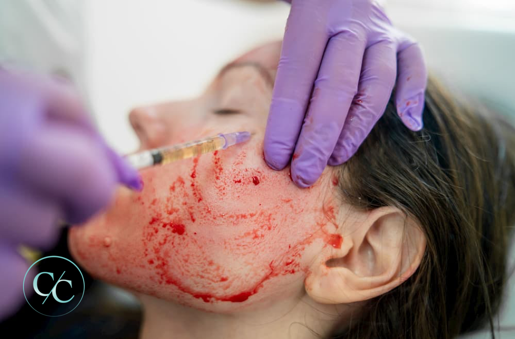 Skin booster model treatment