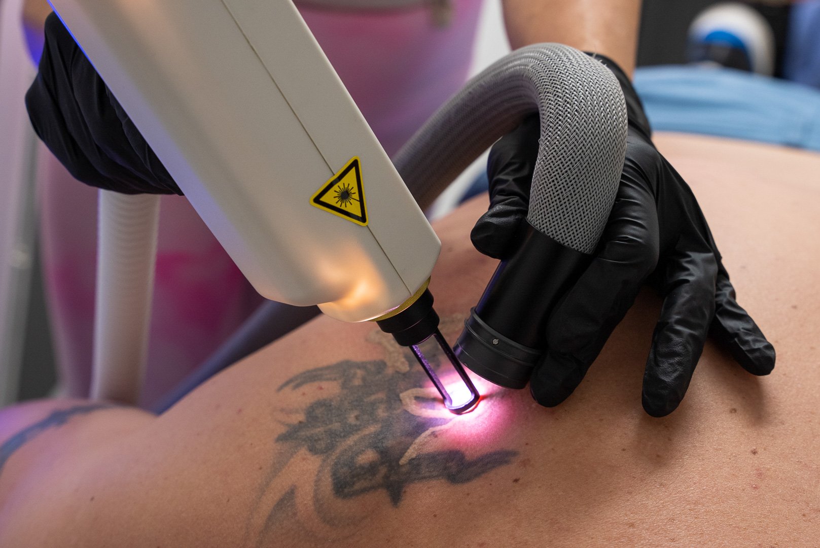 Tattoo removal model treatment